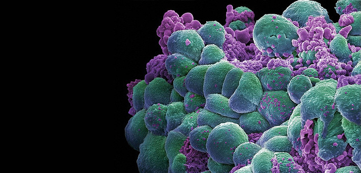 Micrografía electrónica de grupo de células de cáncer de mama. / Annie Cavanagh. Wellcome Images (FLICKR)