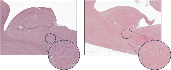 La esclerosis del hipocampo (EH) vista al microscopio. A la izquierda, un hipocampo sin EH (estadio 0) y a la derecha, uno afectado por EH avanzada (estadio IV). Fijándose en el círculo, se puede apreciar la pérdida masiva de neuronas (marcadas en azul) con la EH.