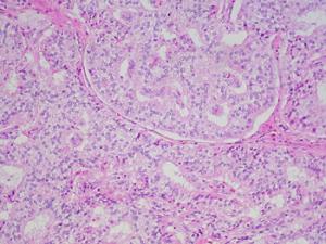 Tumor neuroendocrino bien diferenciado del duodeno. / Ed Uthman (FLICKR)