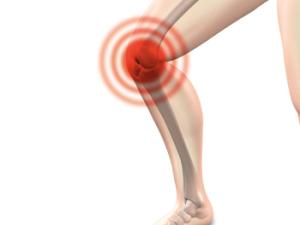 Ilustración de rodilla con artrosis. / naturwohl-gesundheit (PIXABAY)