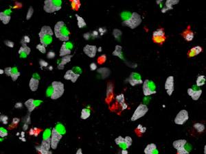 Células progenitoras neuronales humanas (gris) infectadas con el virus Zika (Verde) aumentan la enzima caspase-3 (rojo), lo que sugiere mayor muerte celular. / Sarah C. Ogden, Florida State University, Tallahassee - NIH Image Gallery (FLICKR)