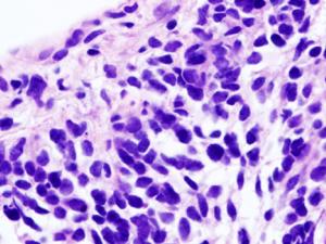 Vista microscópica de una biopsia de carcinoma de pulmón de células pequeñas. / KGH (WIKIMEDIA)