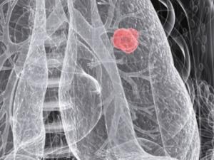 Cancer de pulmon de un hombre de 54 años. / Oregon State University  (FLICKR)