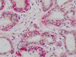 Científicos emplean por primera vez microgeles desarrollados sobre oro esférico para mejorar el tratamiento de cáncer de mama